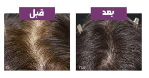 خرید قرص ضد ریزش مو فیتوسیان مکمل ضد ریزش مو ارثی و هورمونی